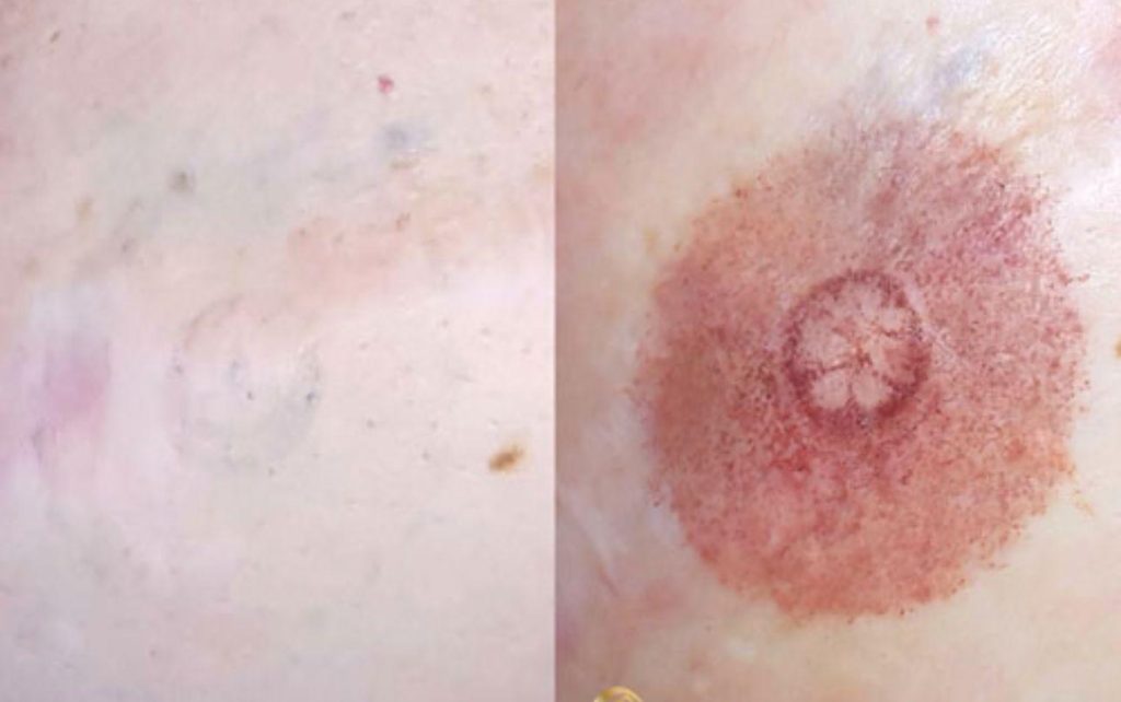 micropigmentacion oncologica